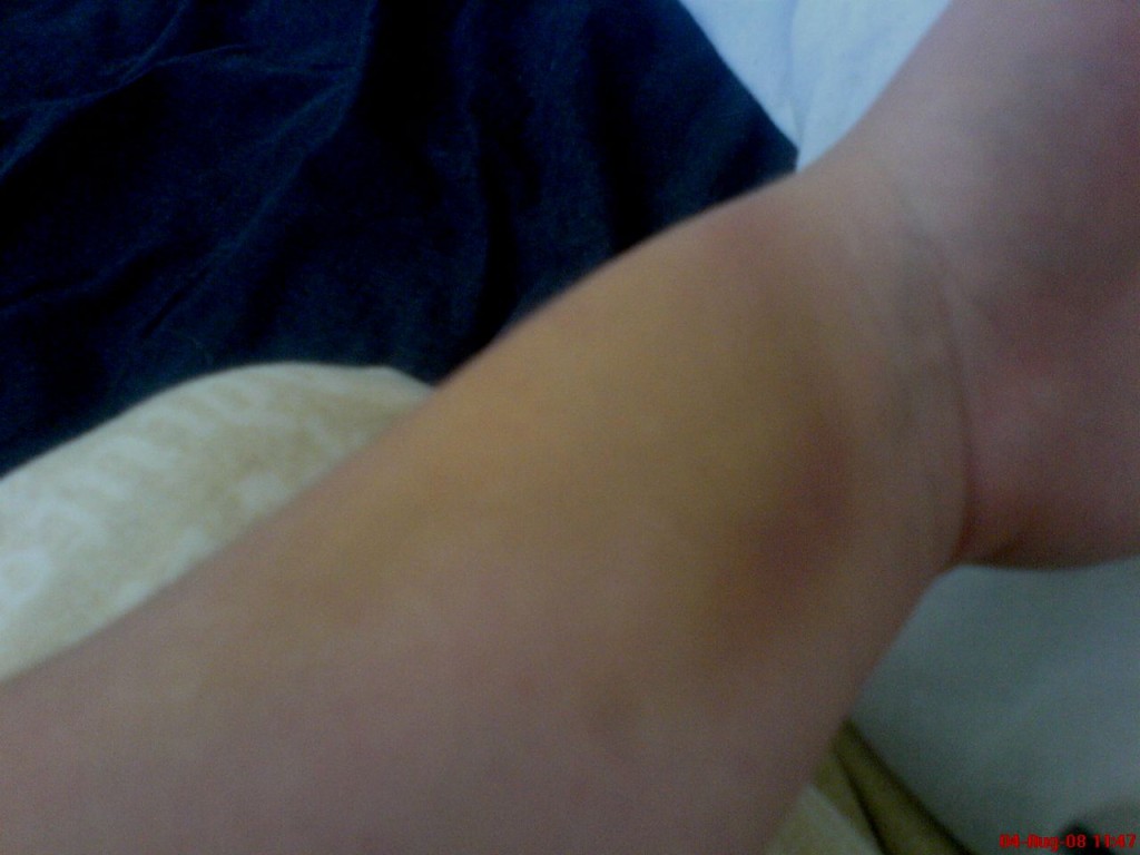 Bruised arm