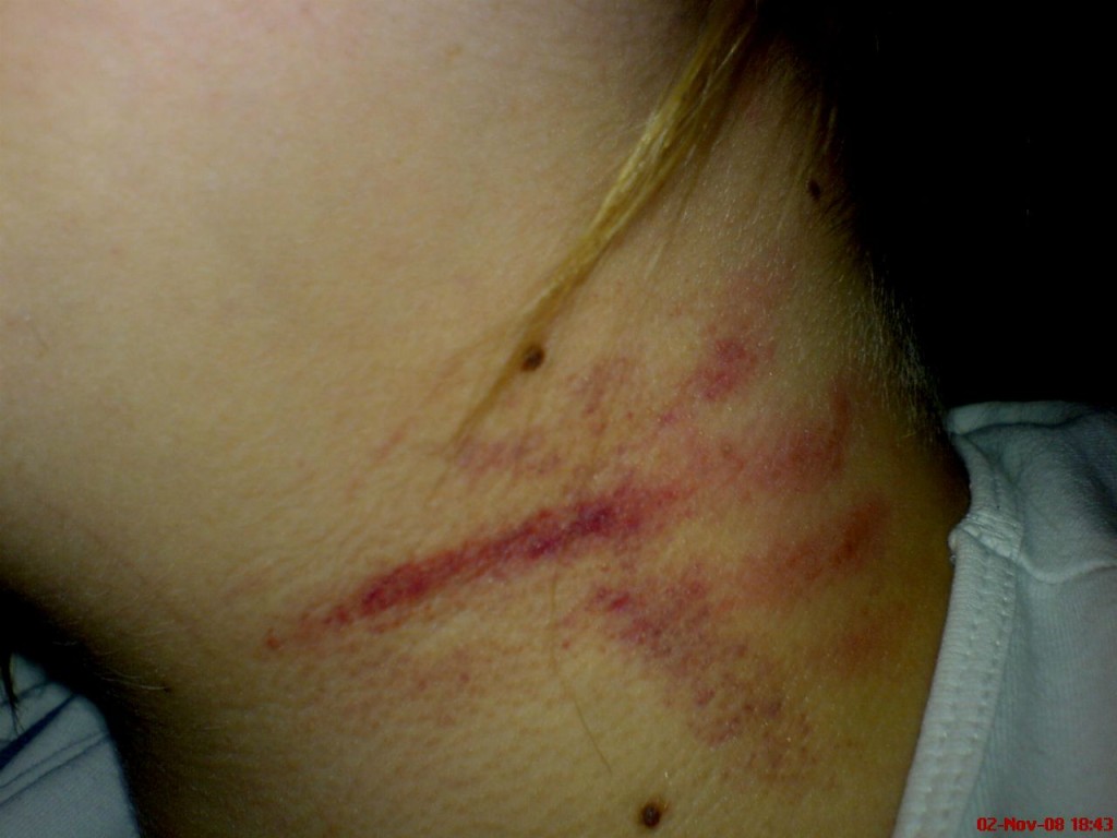 bruised neck